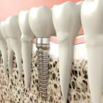 dental implant
